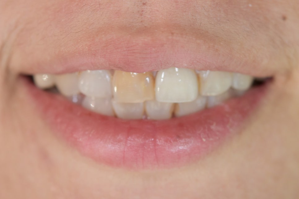 연예인라미네이트 무삭제로 잘하는 2D치과 관련 이미지 5