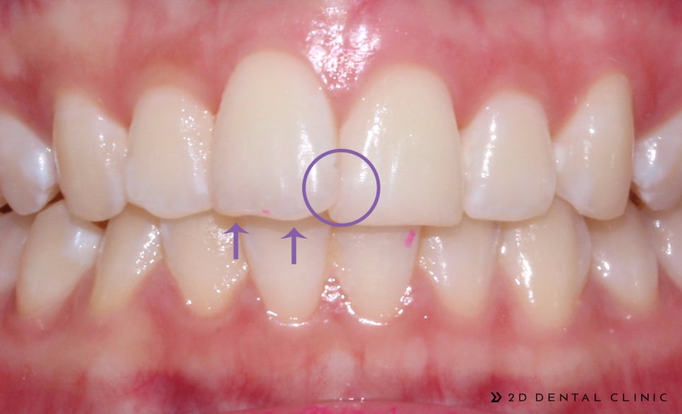앞니 덧니 부분교정 케이스 전후비교, 교정전문 2D치과 관련 이미지 4