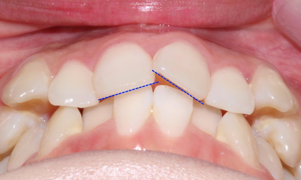 역삼역치과 송곳니덧니 crowding Case 관련 이미지 2