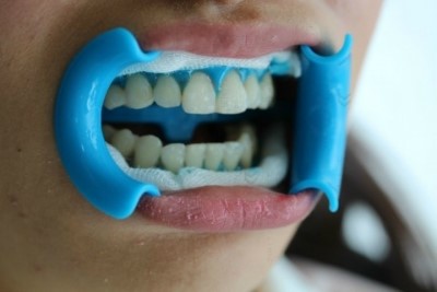 투디치과의 치아미백!! 관련 이미지 1