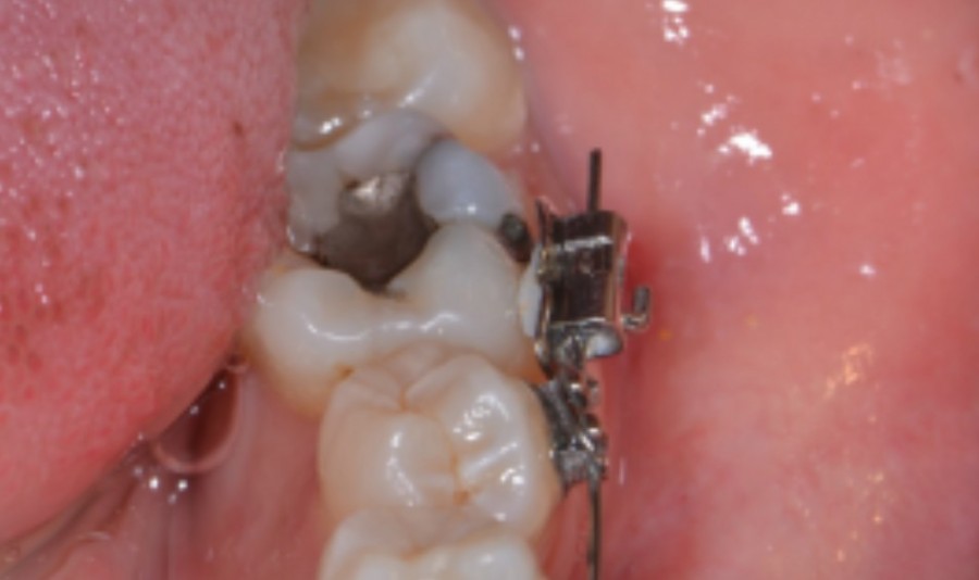 일요일에 문여는 치과  아파죽을것같은데 살려주세요 :: 신논현역 2D치과 관련 이미지 4