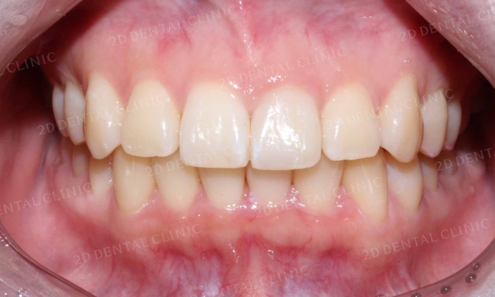 강남역 치과에서 앞니부분 설측 2D(투디)교정으로 토끼앞니 탈출한 후기 관련 이미지 15