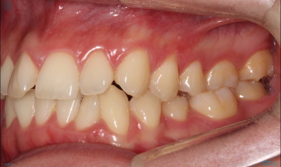 부분교정으로 삐뚤어진 앞니 예뻐지는 방법 관련 이미지 10