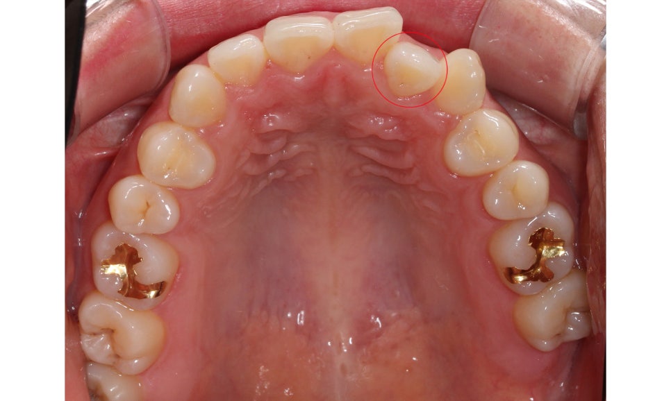 절단교합 클리피씨 교정 방법 관련 이미지 6