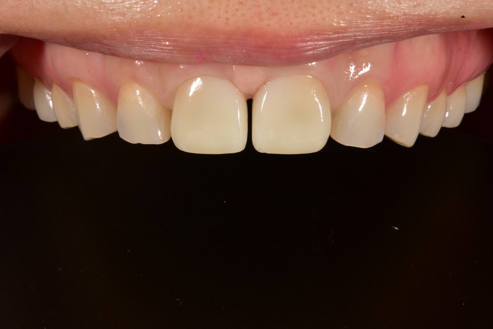 [투디치과] 블랙필름(비스포크) 치료의 다양한 사례 관련 이미지 14