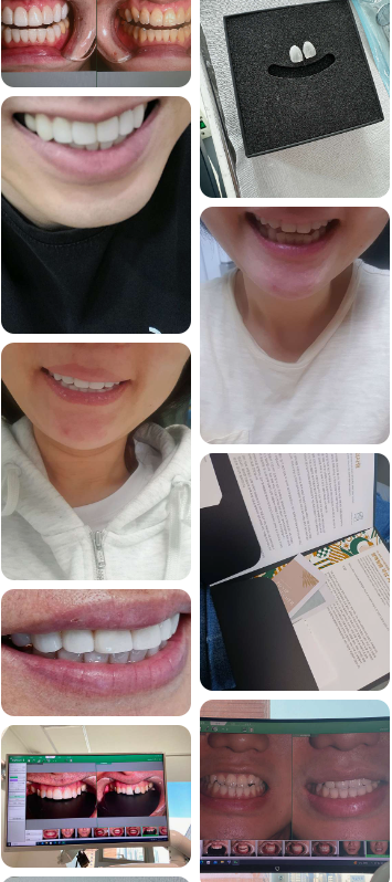 무삭제라미네이트후기 많은 고객님들의 찐후기가 많은 2D치과 관련 이미지 2