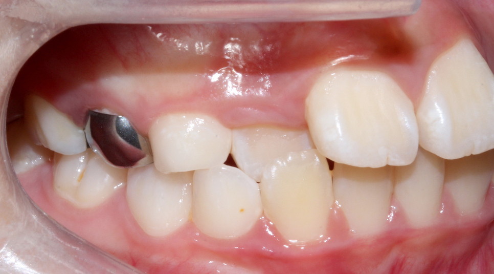 (2D)투디치과: 성장기 어린이 비발치 부정교합 후기 과정. 관련 이미지 2