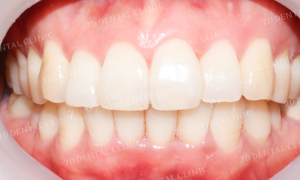 [앞니교정] 돌출앞니교정, 토끼앞니를 클리피씨교정으로 완성하기! by. 투디치과(2D치과) 관련 이미지 10