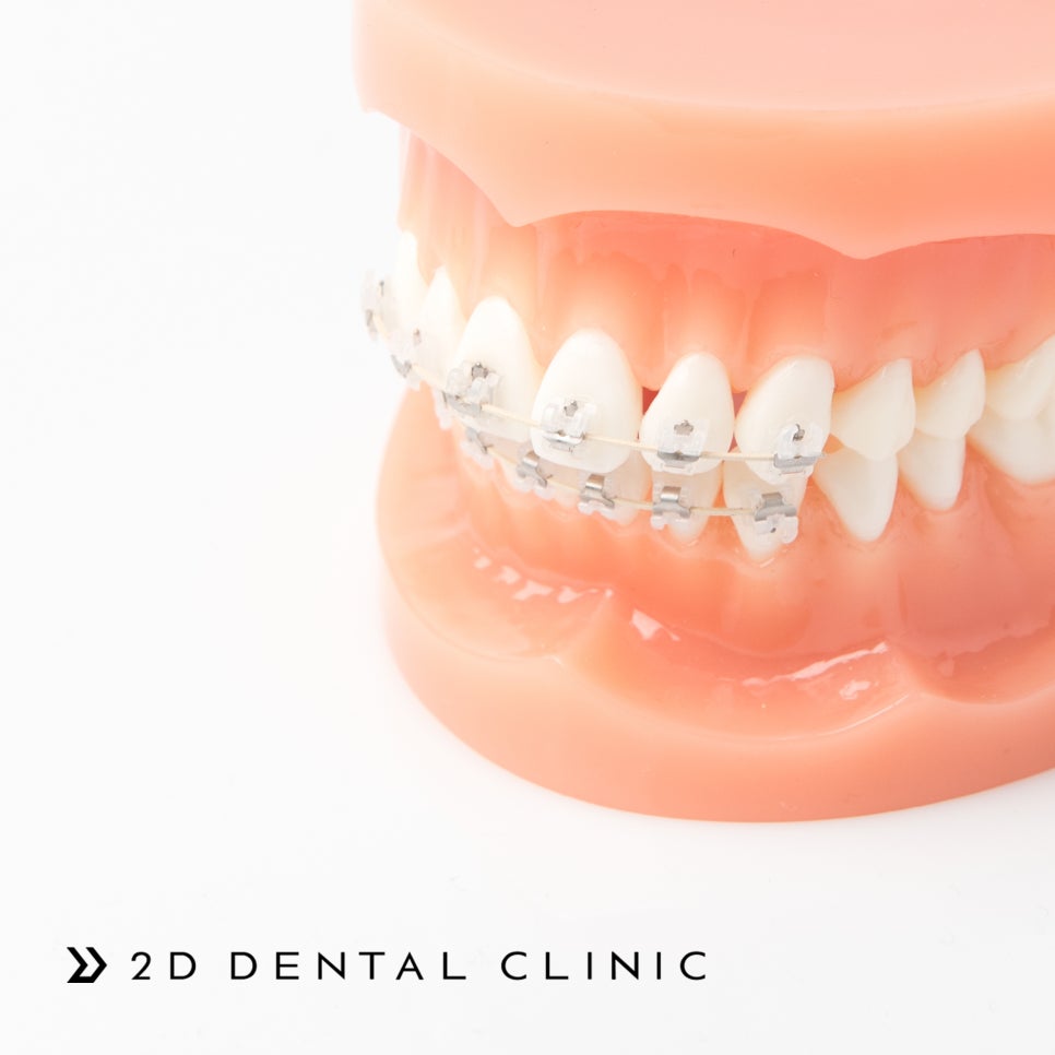 [투디(2D)치과] 치아교정에 화이트 와이어를 선택하는 이유? 관련 이미지 6