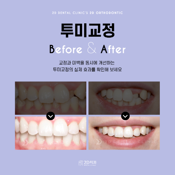 교정과 미백을 동시에! 1DAY 치료 가능한 <투미교정> 관련 이미지 6