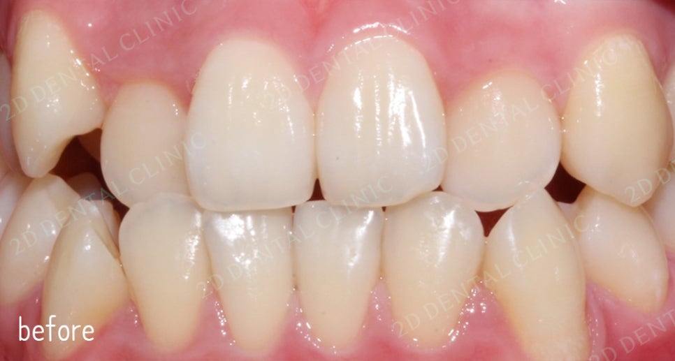 우디의 교정일기ㅣ덧니 치아교정 후기 (feat.부정교합) 관련 이미지 2