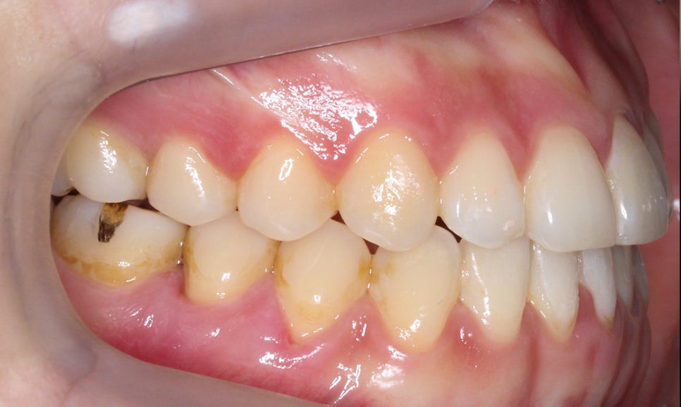 절단교합 클리피씨 교정 방법 관련 이미지 11