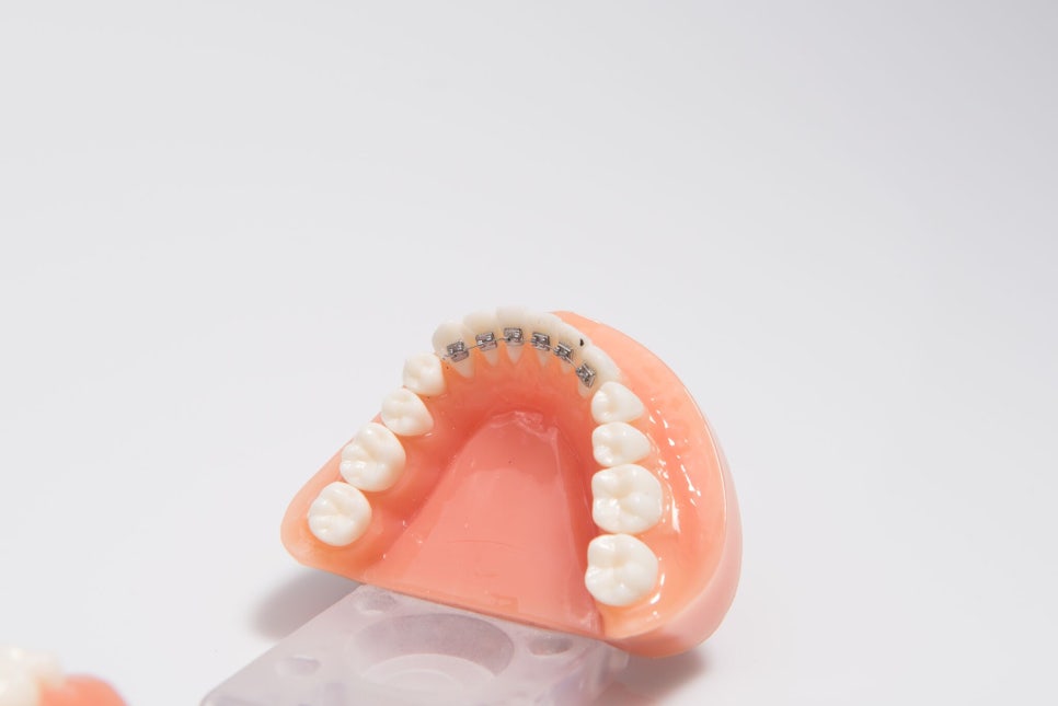 강남역치과[투디치과]투디교정/앞니교정 관련 이미지 4