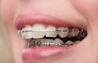 치아교정과 무삭제라미네이트 블랙필름 나에게 맞는 시술찾기 관련 이미지 5