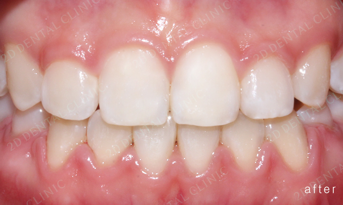 우디의 교정 일기ㅣ부정 교합 치아교정 후기 관련 이미지 3