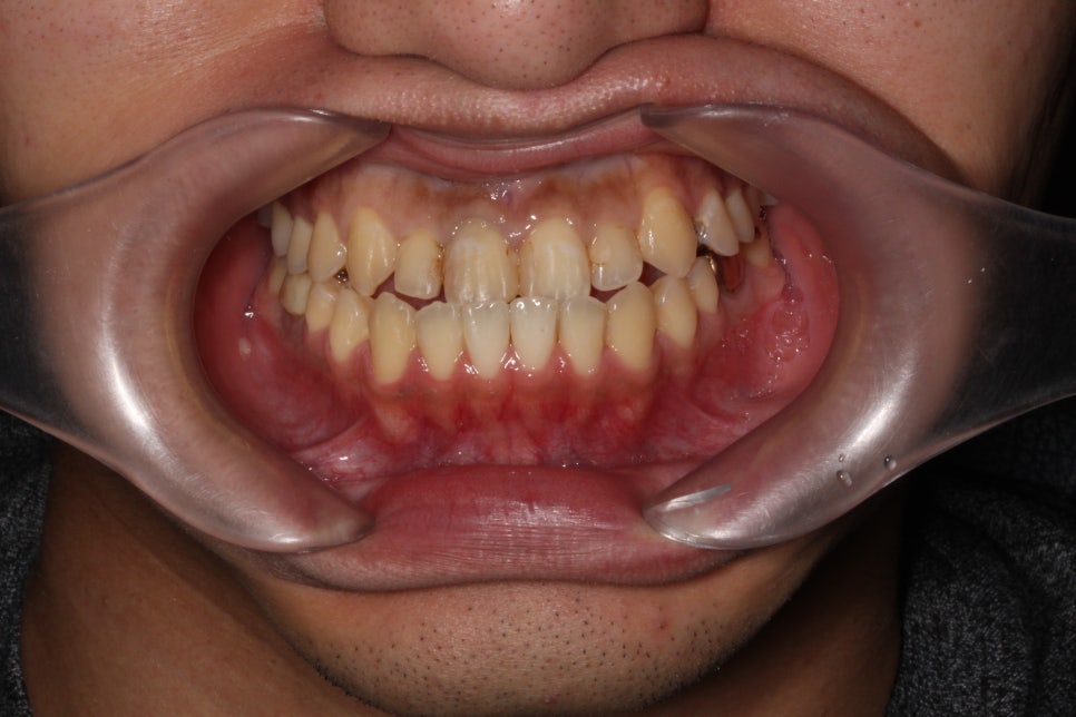 2D(투디)치과 블링스, 추천합니다!(깨진 앞니, 돌출앞니, 벌어진 앞니, 치아 노후, 치아 변색) 관련 이미지 4