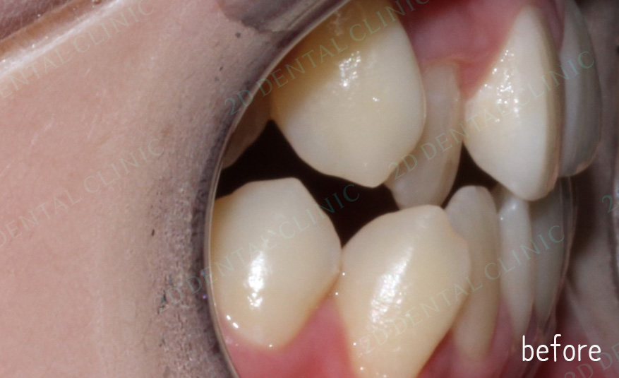 우디의 교정일기ㅣ덧니 치아교정 후기 (feat.부정교합) 관련 이미지 10