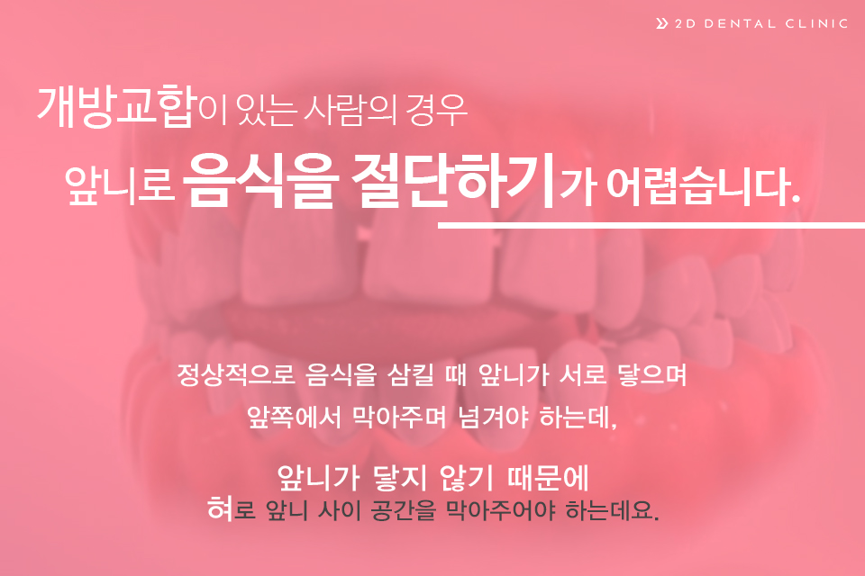 개방교합, 교정으로 잇몸질환 예방하자! 관련 이미지 4