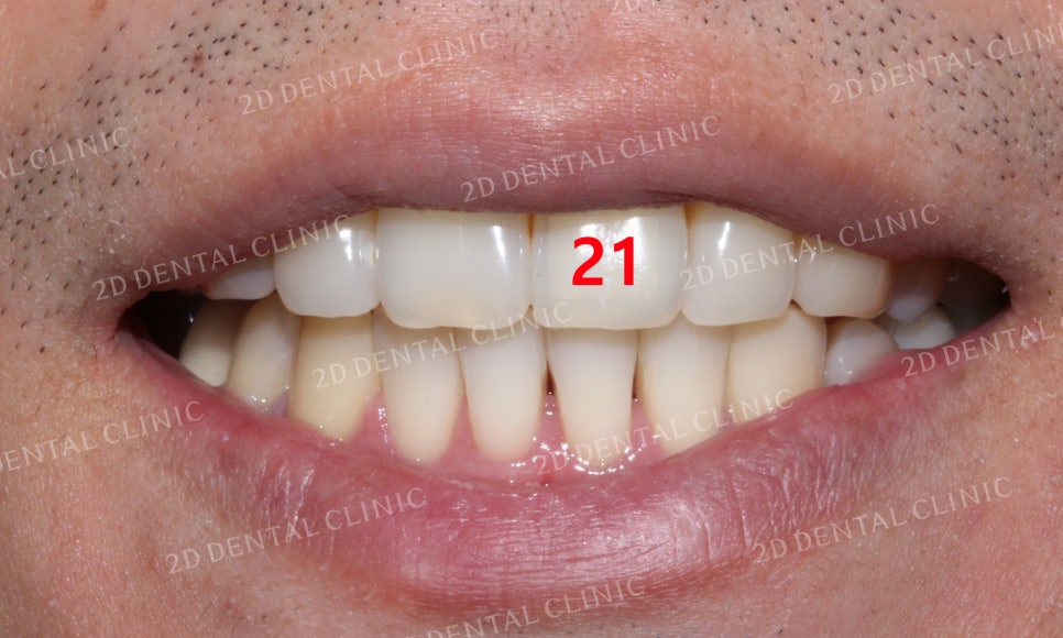 틀어진 앞니를 전체 교정으로 바르게! by.투디치과(2D치과) 관련 이미지 12