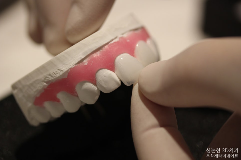 강남라미네이트치과 추천 : 진짜 무삭제, 투디치과! 관련 이미지 2