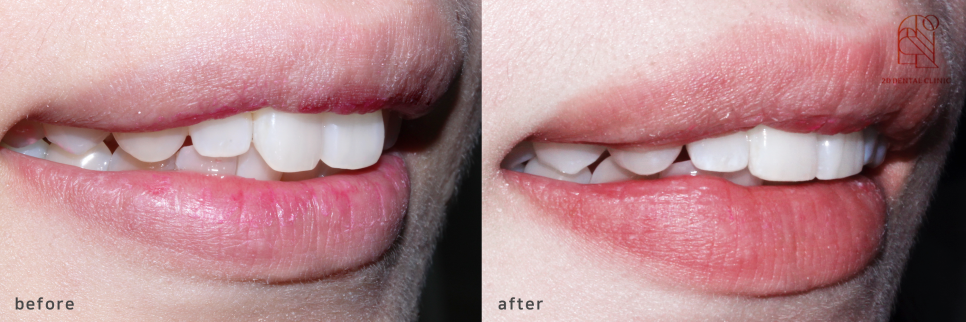 2D치과(투디치과)교정일기 ㅣ 연예인이 많이하는 2D교정 토끼이빨 case 관련 이미지 1