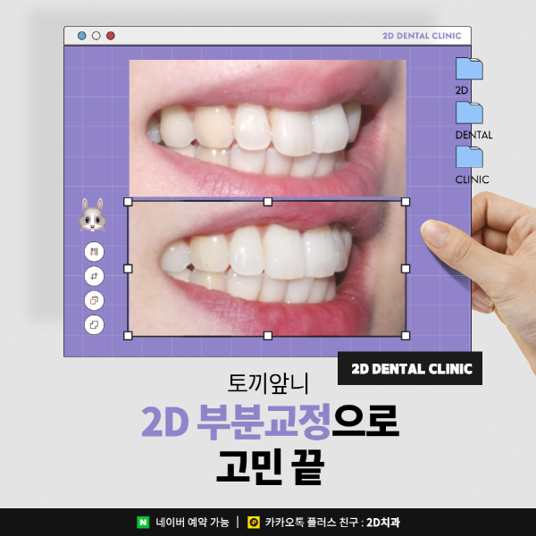 수지처럼 토끼앞니라면? 2D부분교정으로 개선 가능 관련 이미지 1