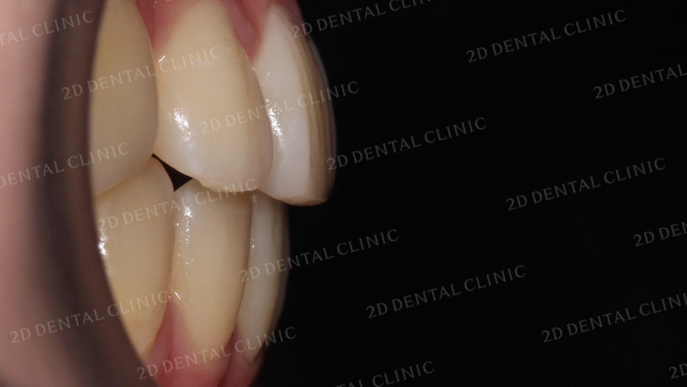 덧니치아교정, 클리피씨 전체교정으로 완벽하게! by.투디치과(2D치과) 관련 이미지 11