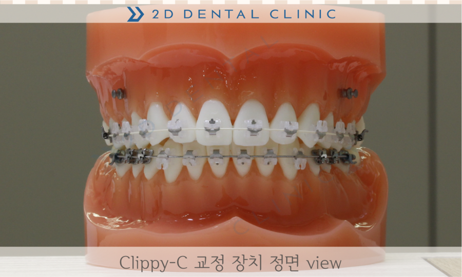 [교정상식] 전체교정 장치 종류 및 장단점! 관련 이미지 2