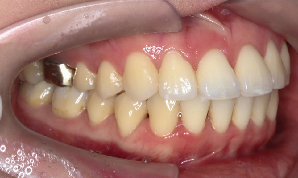 입툭튀 교정 신논현역치과 전체교정으로 관련 이미지 11