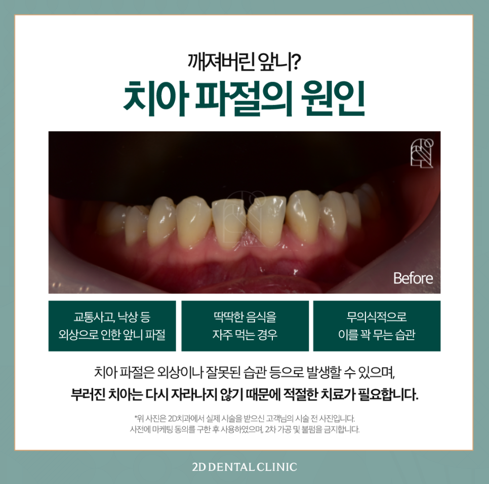 강남역치과 치아끝깨짐 첫인상을 좌우하는 요인! 관련 이미지 3