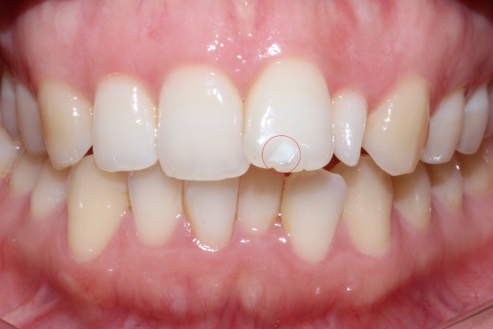 왜소치 뻐드렁니 교정 신논현역치과에서 관련 이미지 4