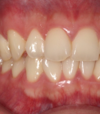 부분교정으로 삐뚤어진 앞니 예뻐지는 방법 관련 이미지 11