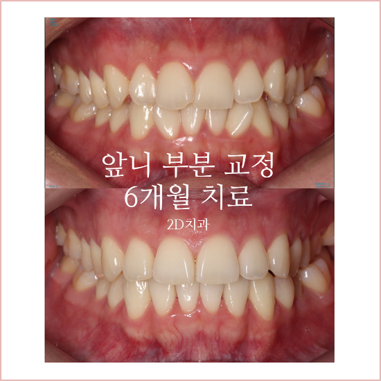 부분교정으로 삐뚤어진 앞니 예뻐지는 방법 관련 이미지 23