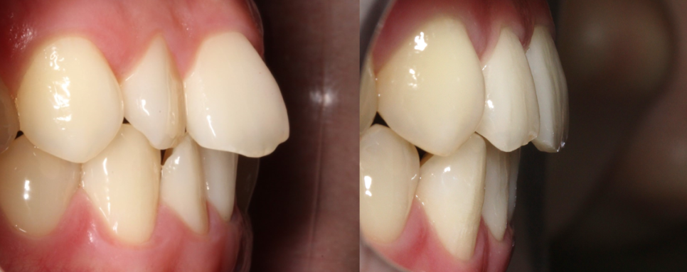 부분교정으로 삐뚤어진 앞니 예뻐지는 방법 관련 이미지 16