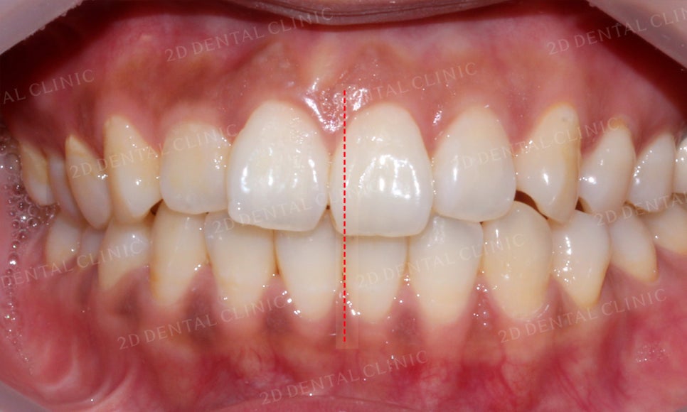 [2D교정] 나비치아, 앞니교정 설측교정으로 빠르게 하는 방법! by.2D치과(투디치과) 관련 이미지 5