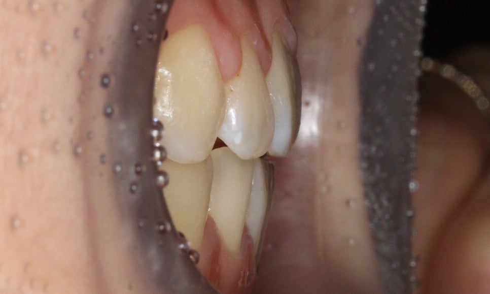 나비앞니 세라믹교정 case 관련 이미지 10