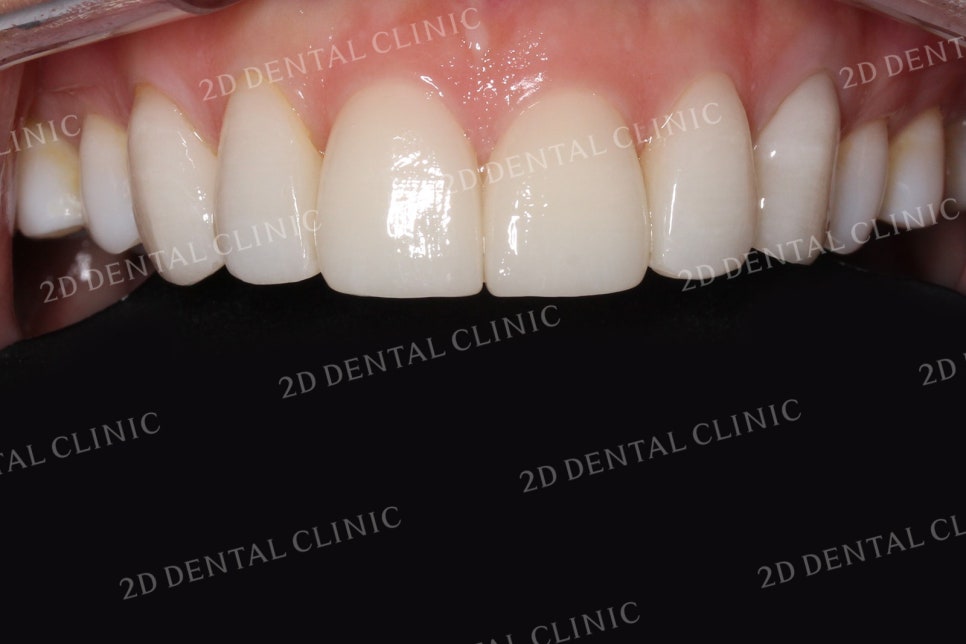 치아틈새를 완벽하게 메꾸자! 블랙트라이앵글 쎄라필름으로 완전 삭제! by.투디치과(2D치과) 관련 이미지 12