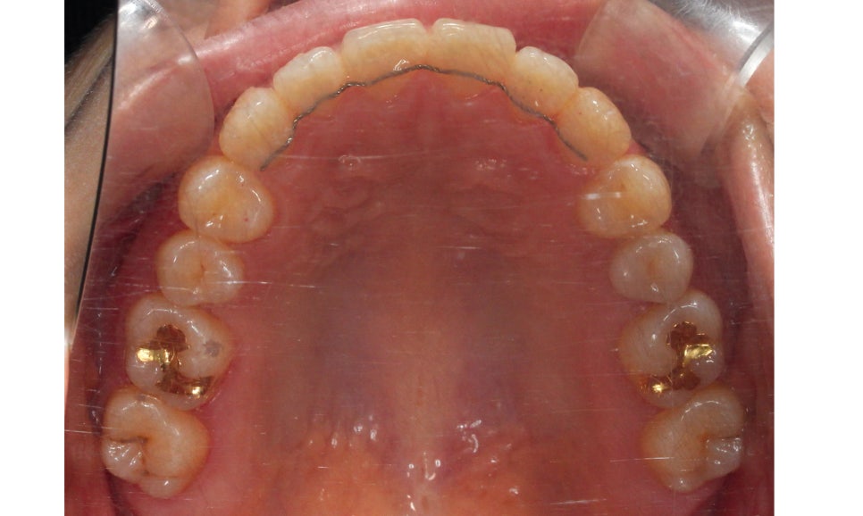 절단교합 클리피씨 교정 방법 관련 이미지 13