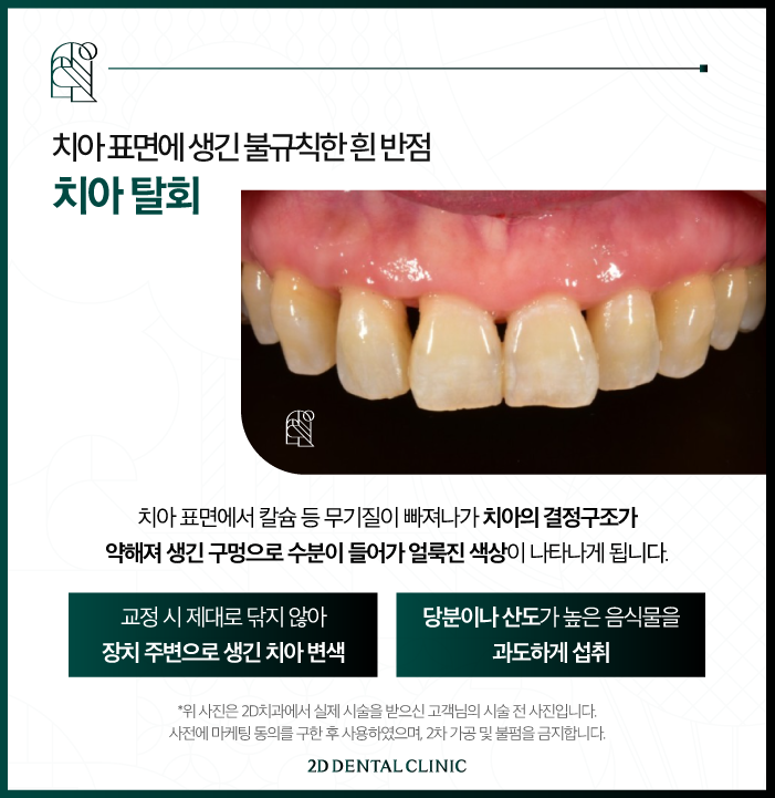 광주무삭제라미네이트 블랙필름으로 치아 반점 개선하기 관련 이미지 3