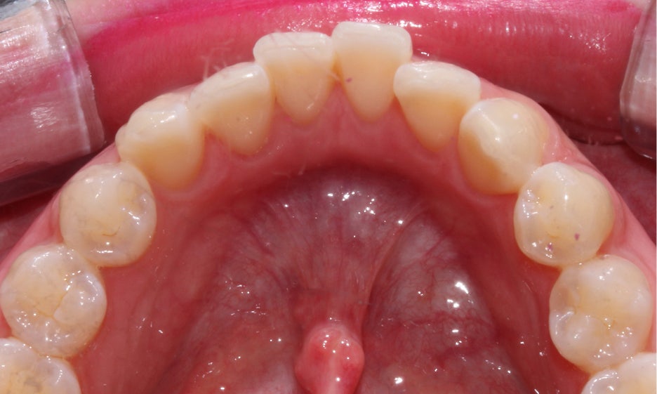 반포치과 뻐드렁니교정 방법은? 관련 이미지 6