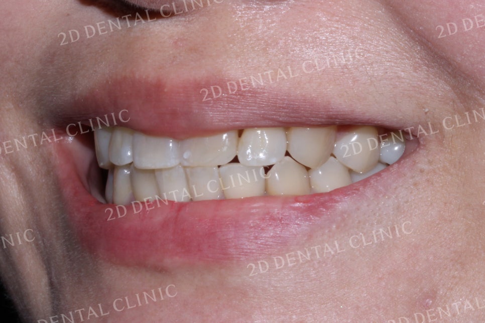 반대교합으로 물리는 치아를 바른 교합으로 교정하기! by.투디치과(2D치과) 관련 이미지 11