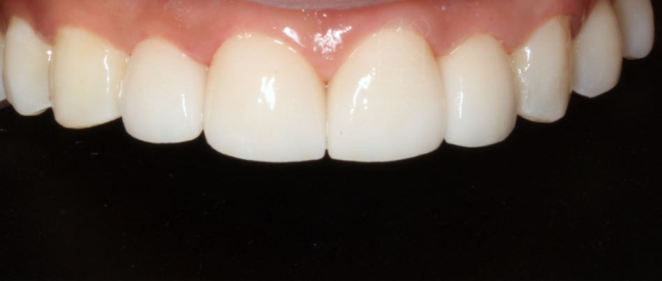 앞니라미네이트 치아삭제없는 무삭제라미네이트 블랙필름 관련 이미지 4