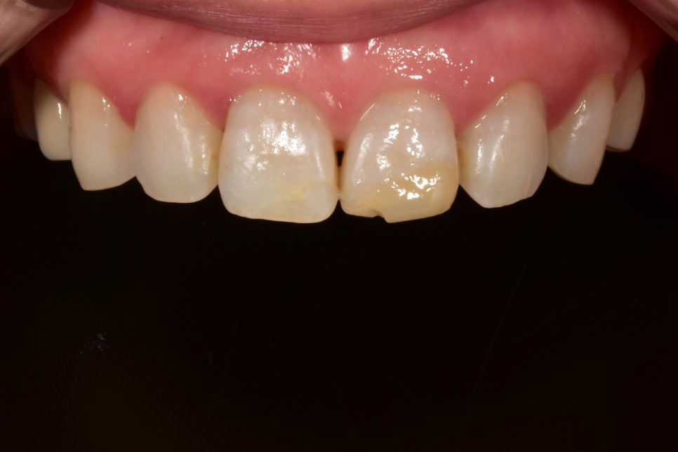 [투디치과] 블랙필름(비스포크) 치료의 다양한 사례 관련 이미지 27