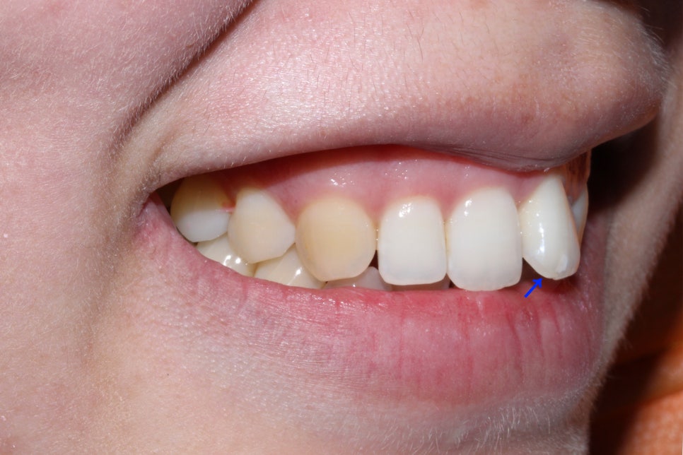 왜소치 뻐드렁니 교정 신논현역치과에서 관련 이미지 3