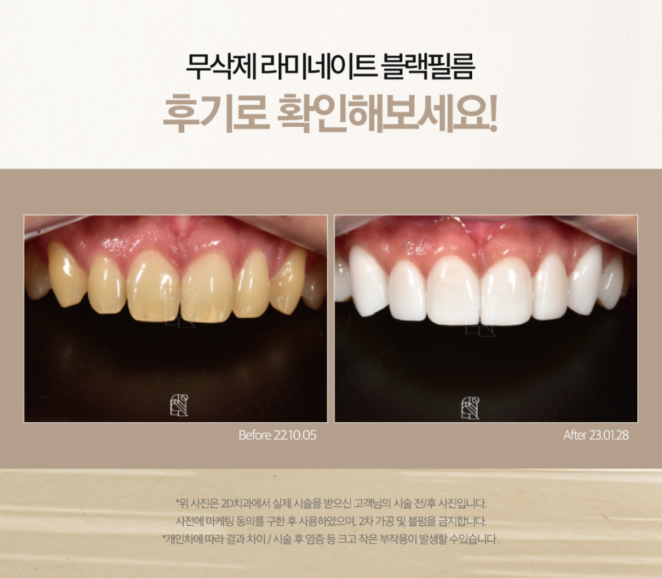 일산무삭제라미네이트 치과치아미백후기 블랙필름으로 변화된 얼굴 관련 이미지 7