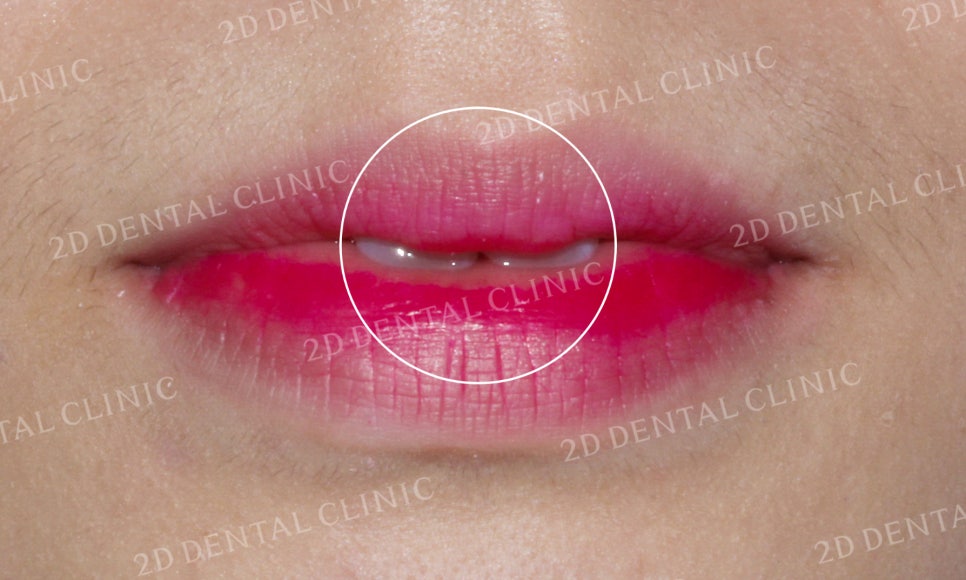 [앞니교정] 부정교합 교정, 앞니교정으로 부정교합 교정하는 방법! by. 투디치과(2D치과) 관련 이미지 2