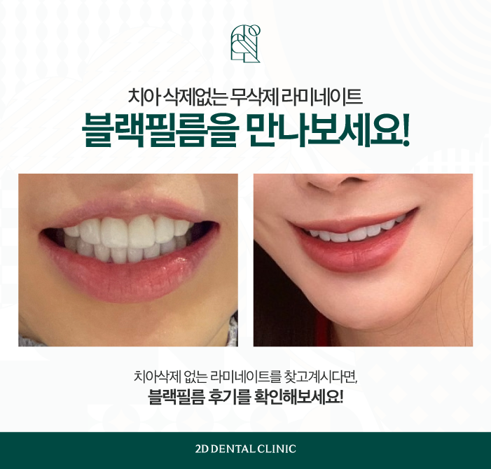강남무삭제라미네이트 2D치과 블랙필름 효과는? 관련 이미지 5