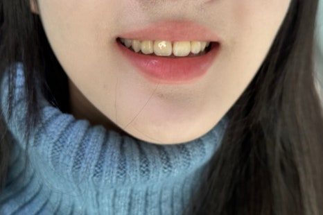 무삭제 라미네이트 개인의 치아디자인에 맞춘 단 하나밖에 없는 치아디자인 블랙필름 관련 이미지 6