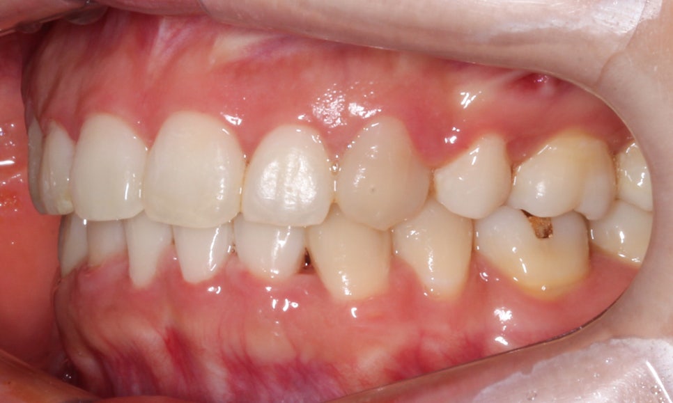 역삼역치과 송곳니덧니 crowding Case 관련 이미지 12