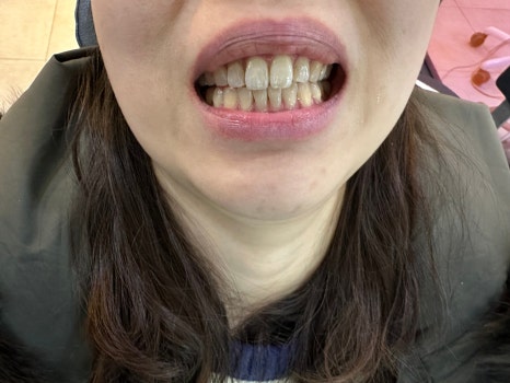 무삭제라미네이트 블랙필름 케이스 비포 에프터 후기 관련 이미지 6